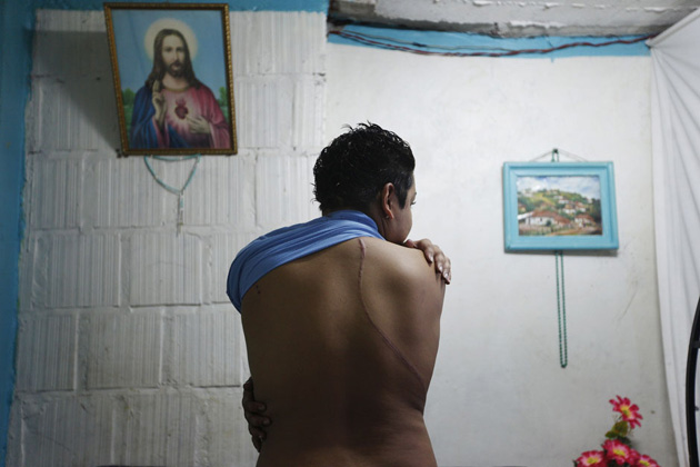 Гомосексуалист показывает шрам от удара ножом в Гондурасе