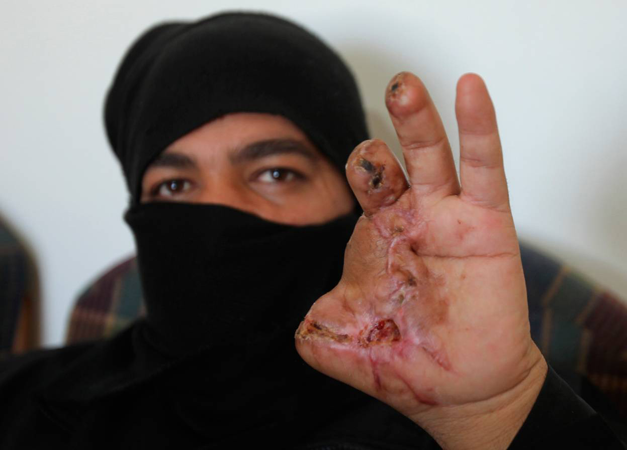 Сириец показывает серьёзную травму руки, Иордания, 13 февраля 2012 года. Reuters / Ali Jarekji